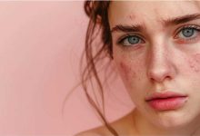 معجزه خانگی از بین بردن جوش برای خانم ها